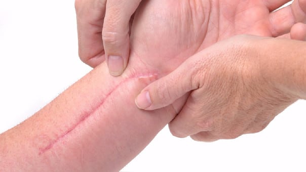 Importancia de la Fisioterapia en el tratamiento de las cicatrices